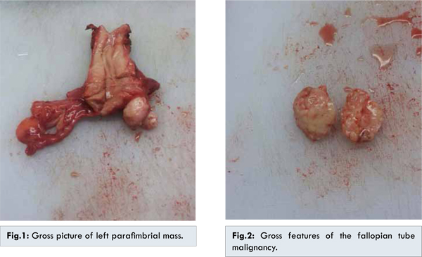 Primary Fallopian Tube Carcinoma Presenting as Inguinal